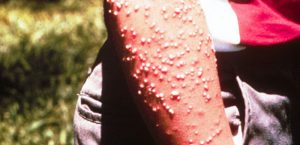 Pustules from fire ant stings. Photo: Murray S. Blum, The University of Georgia