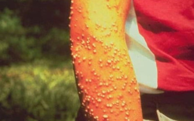 fire ant attacks on humans supplied Texas University fire ant attacks on humans supplied Texas University